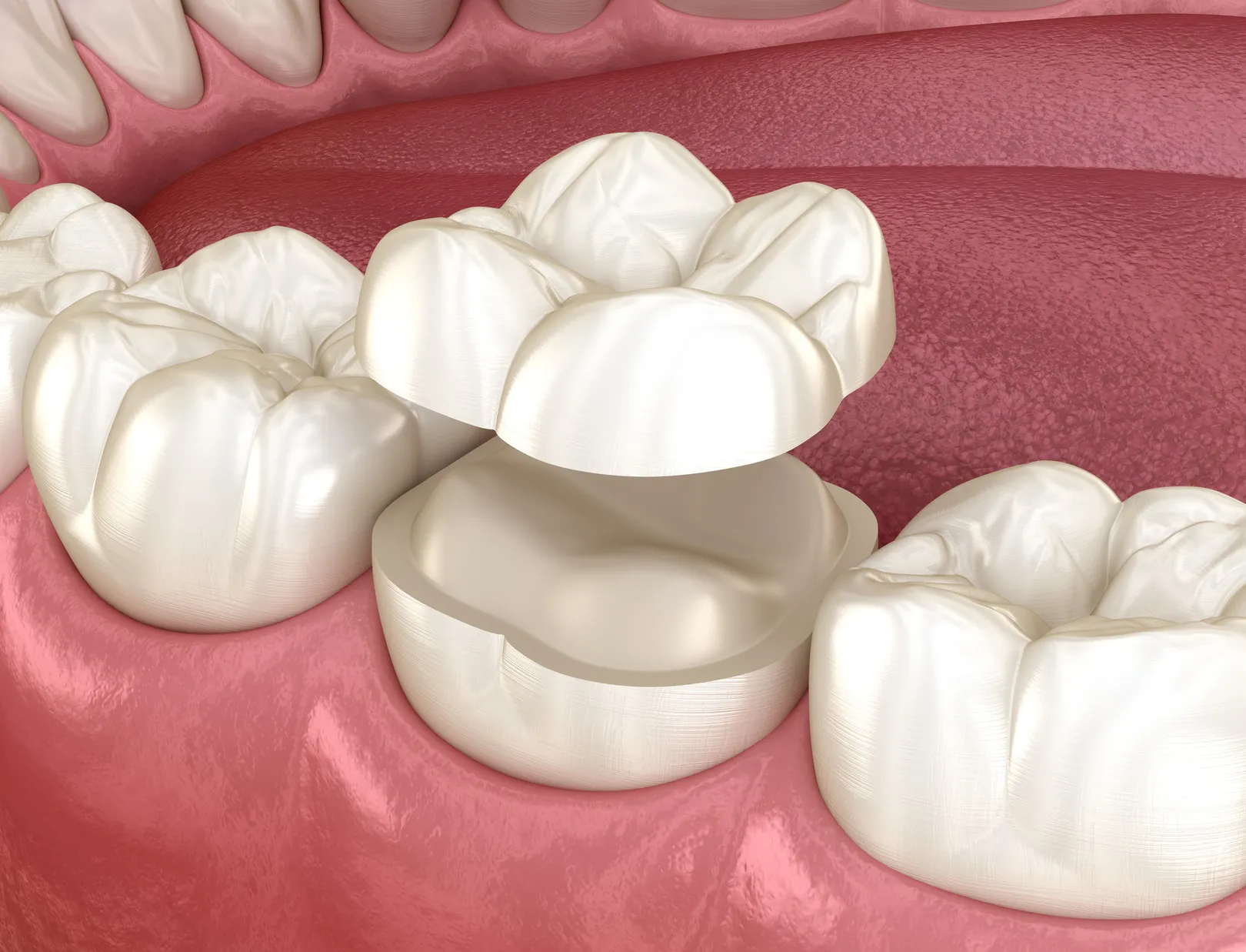 Onlay Restorations