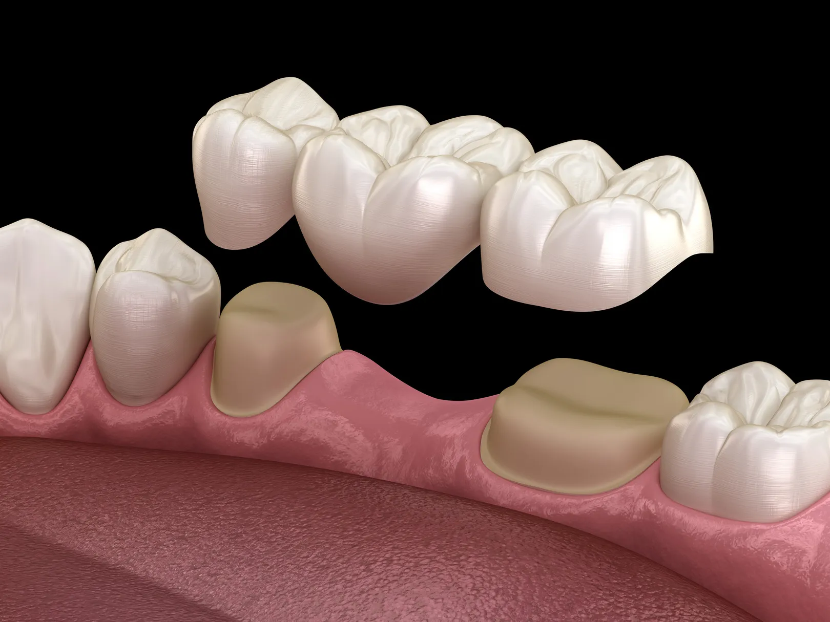 Fixed Dental Bridges in River Oaks, TX