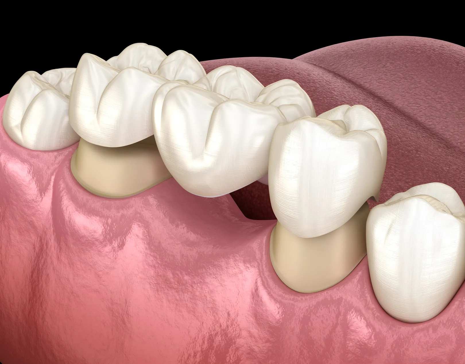 Porcelain Fixed Bridges